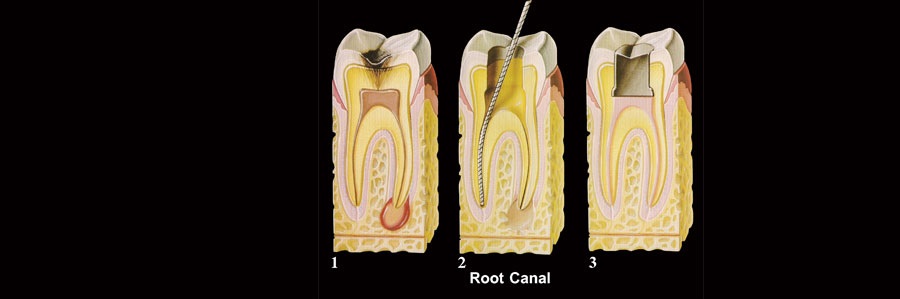 ریشه دندان