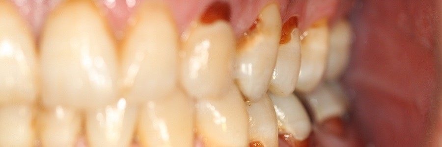 ویتامین D و پوسیدگی دندان