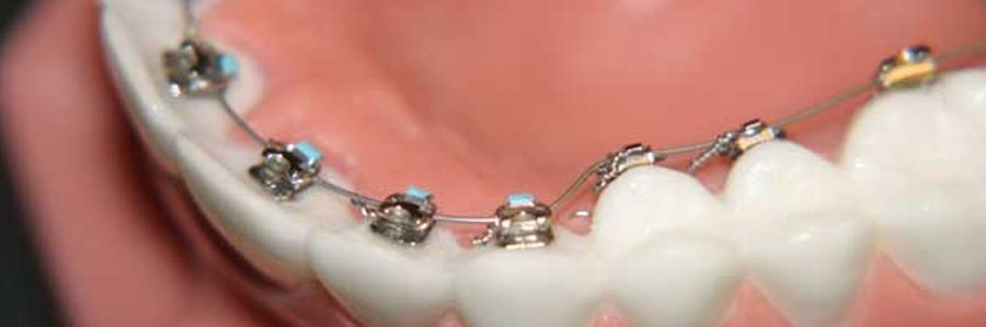 بهترین سن درمان انواع ناهنجاریهای دندانی و فکی