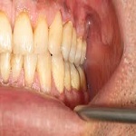 روشهای پیشگیری از پوسیدگی دندان