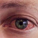 علل و علائم عفونت چشم چیست ؟