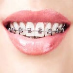 آیا کسانی که دندانشان روکش دارد هم می توانند ارتودنسی کنند؟