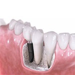 مهم ترین بخش های جراحی ایمپلنت دندان کدامند؟