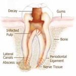 اندو یا اندودونتیکس(درمان ریشه دندان) چیست ؟